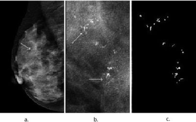 Are Breast Calcifications a Sign of Cancer?
